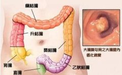 腹泻的人请注意！这3种偏爱找上门